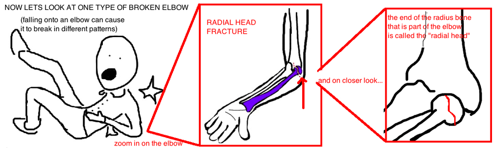 brokenelbowradialheadfracture